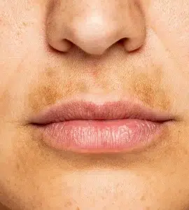 manchas labios iml clinic