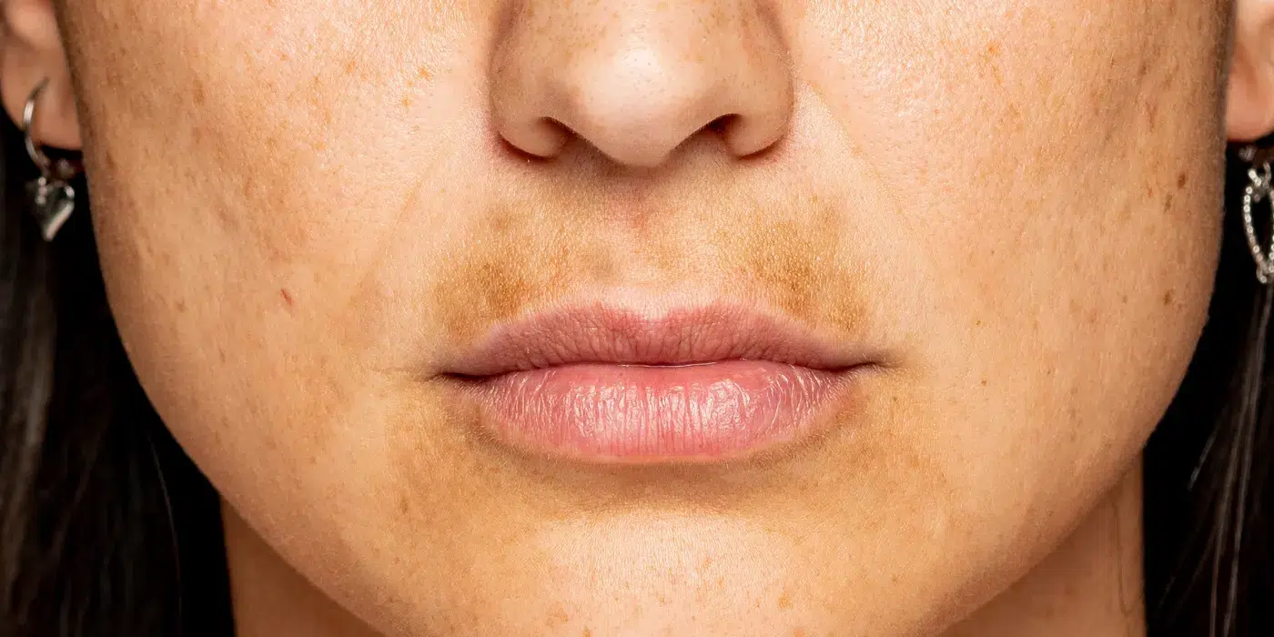 melanotica labial cancer manchas negras en los labios Clinical Cases - Dr. Horacio Cabo