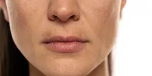 melasma iml clinic