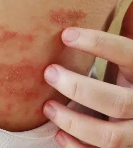 Dermatitis atópica vs seborreica: diferencias