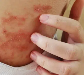 Dermatitis atópica vs seborreica: diferencias