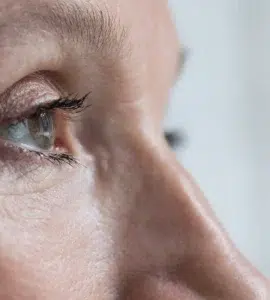 blefaroplastia laser co2