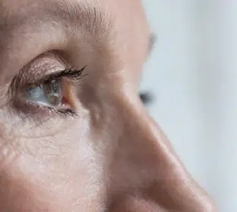 blefaroplastia laser co2