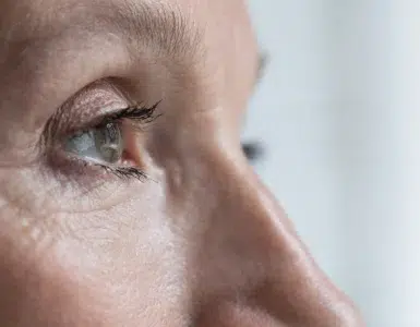 blefaroplastia laser co2