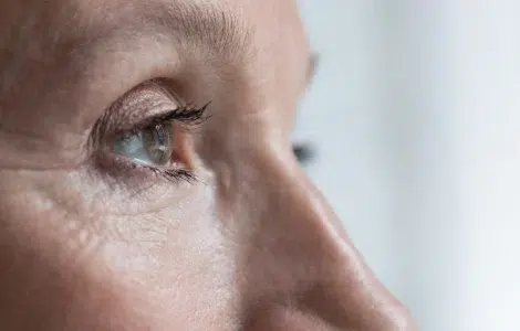blefaroplastia laser co2