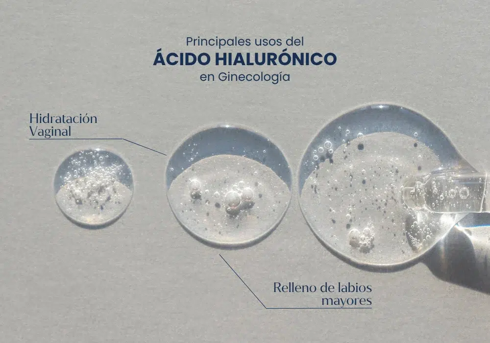 acido hialuronico en ginecologia