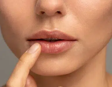 Ácido hialurónico para labios