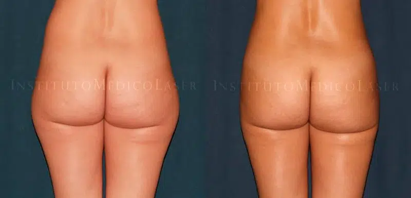 Lipovaser antes y después en cartucheras