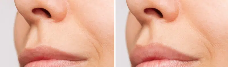 Definir el arco de cupido en labios, antes y después