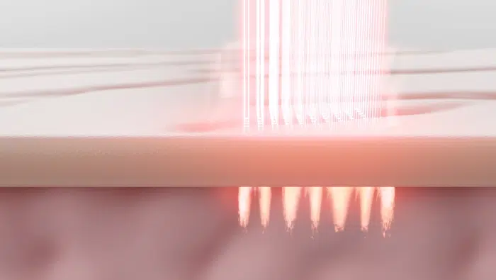 El láser crea microcanales para la absorción de los exosomas