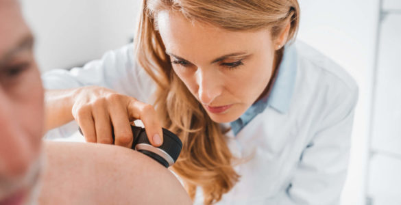 queratosis seborreica o melanoma: como distinguirlos