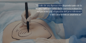 liposuccion abdomen