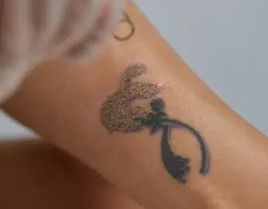 Cómo eliminar un tatuaje de forma segura