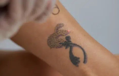 Cómo eliminar un tatuaje de forma segura