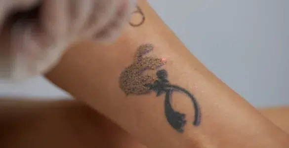 Cómo eliminar un tatuaje de forma segura