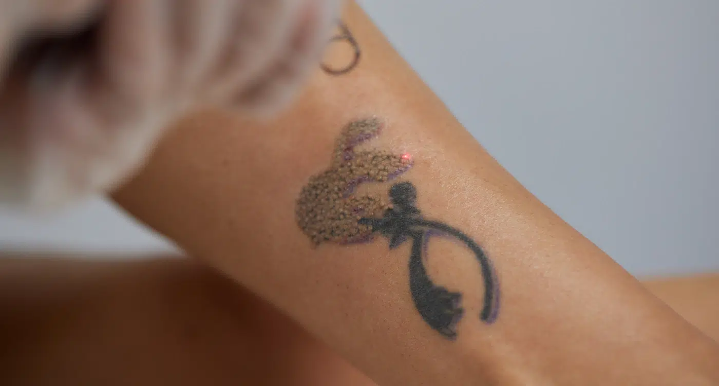 Cómo eliminar un tatuaje de forma segura