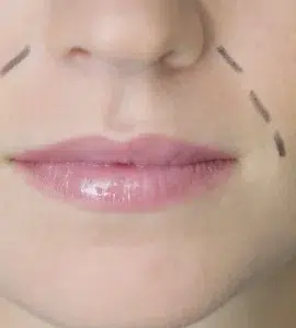 Arrugas del surco nasogeniano