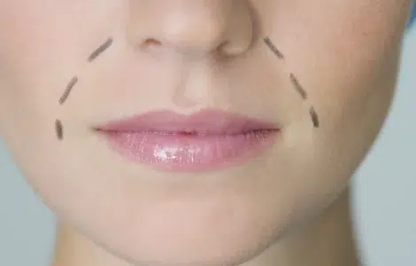 Arrugas del surco nasogeniano