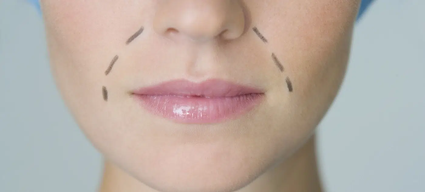 ¿Cómo eliminar las arrugas del surco nasogeniano?