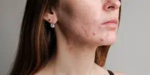 acne en termpoara de navidad