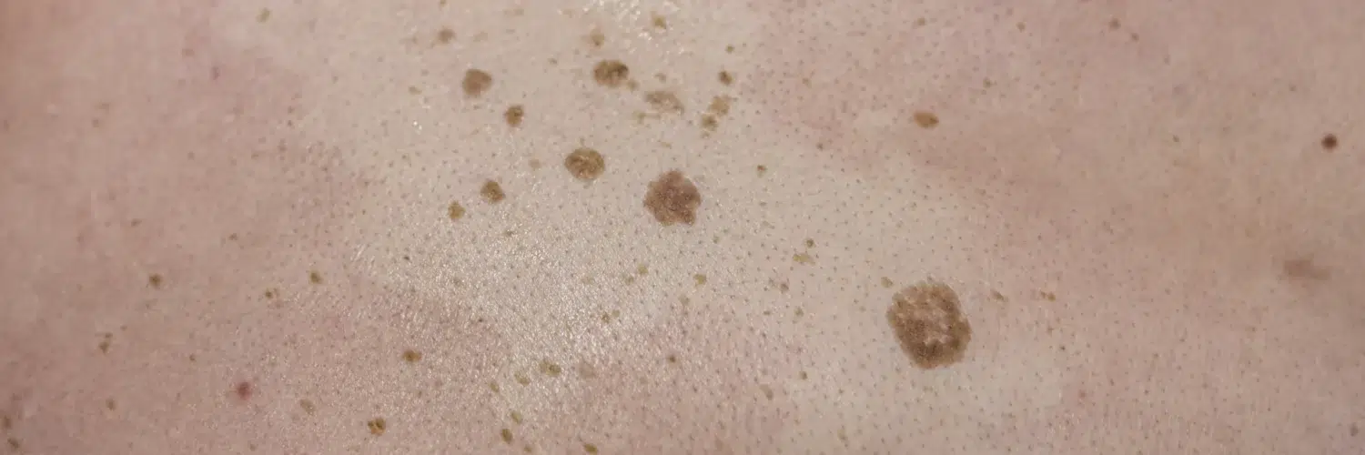 Queratosis seborreicas