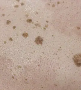 Queratosis seborreicas