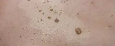 Queratosis seborreicas