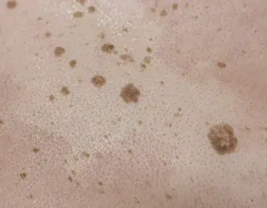 Queratosis seborreicas