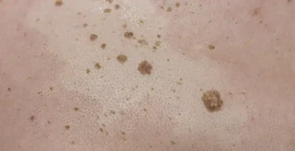 Queratosis seborreicas