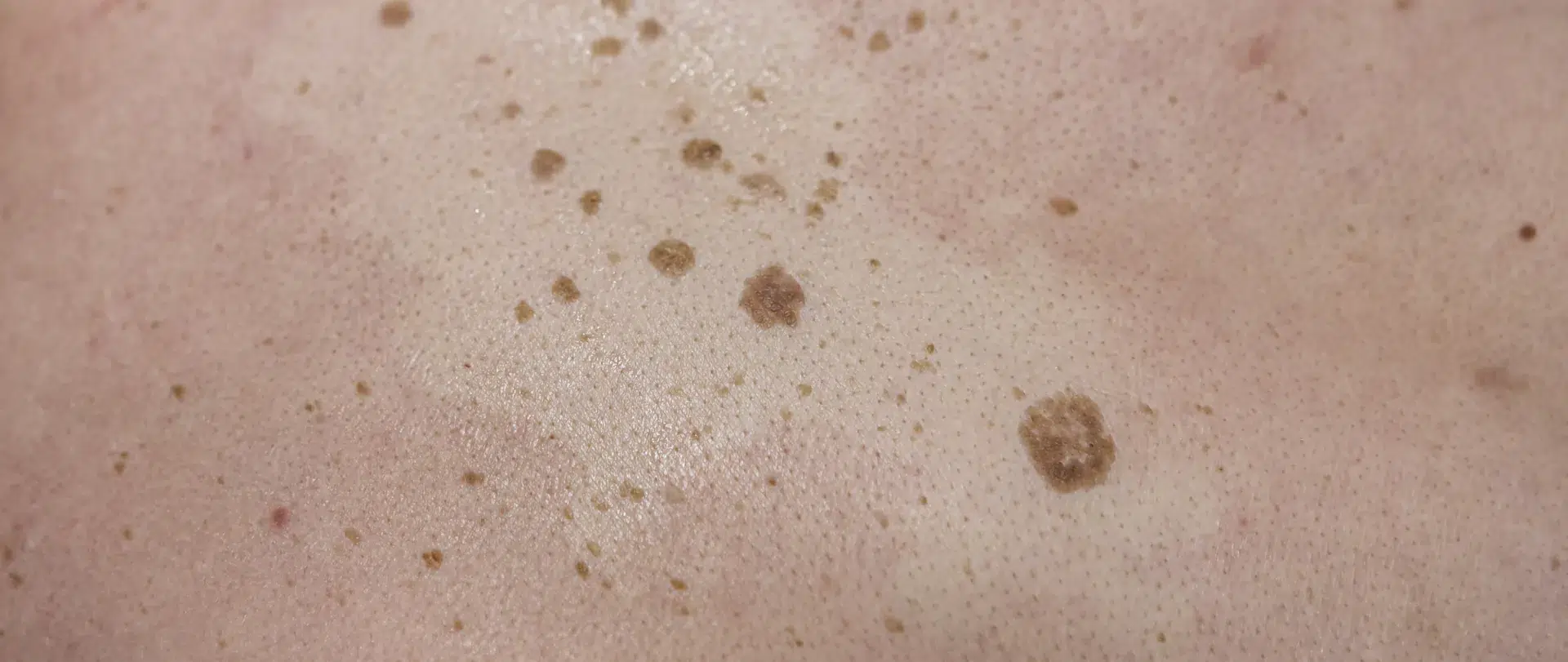 Qué es, causas, síntomas y tratamientos de la queratosis seborreica