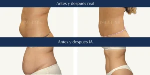 Antes y después lipo