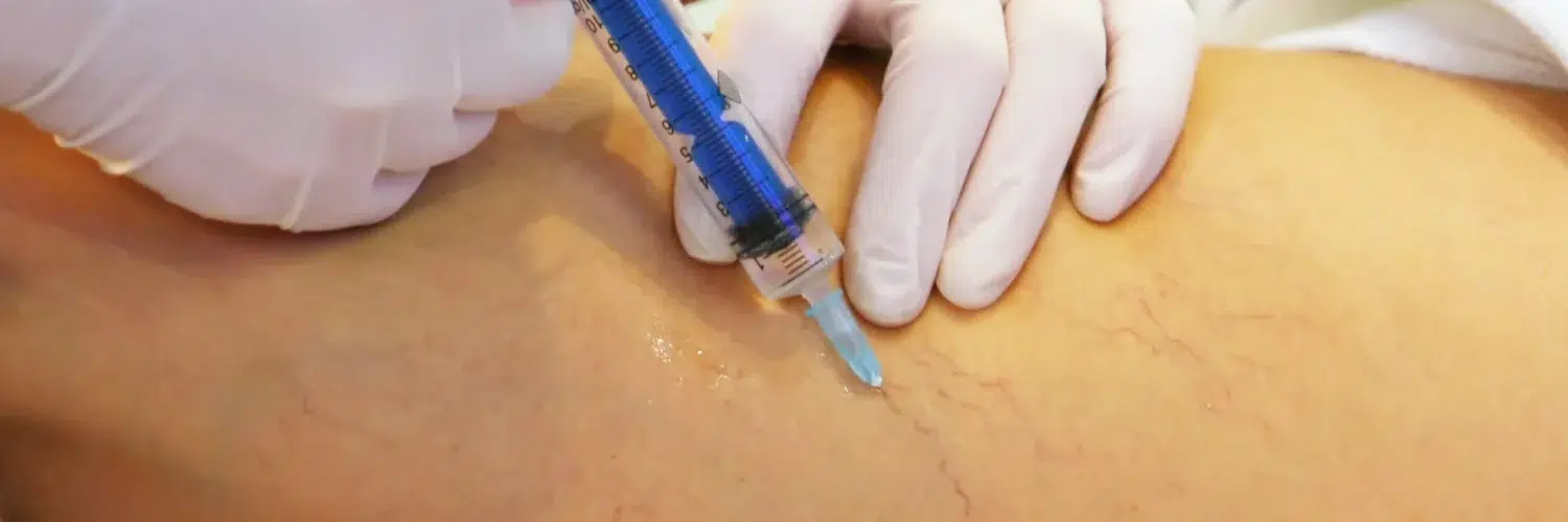 Guía práctica de escleroterapia de varices