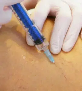 Guía práctica de escleroterapia de varices