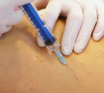 Guía práctica de escleroterapia de varices