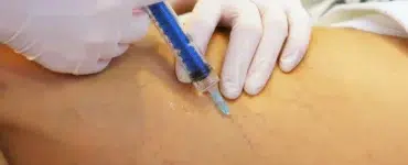 Guía práctica de escleroterapia de varices