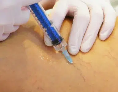 Guía práctica de escleroterapia de varices