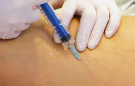 Guía práctica de escleroterapia de varices
