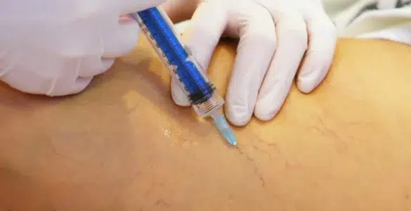 Guía práctica de escleroterapia de varices