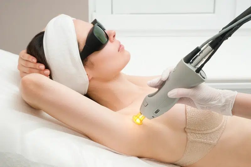 Láser alejandrita para depilación láser en IML Clinic Madrid