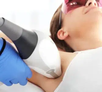 Depilación Láser en axilas con Vectus