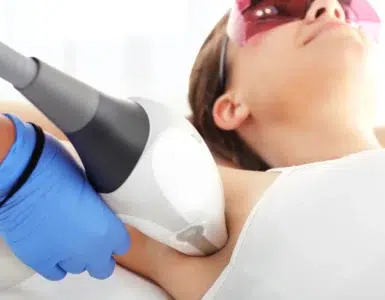 Depilación Láser en axilas con Vectus
