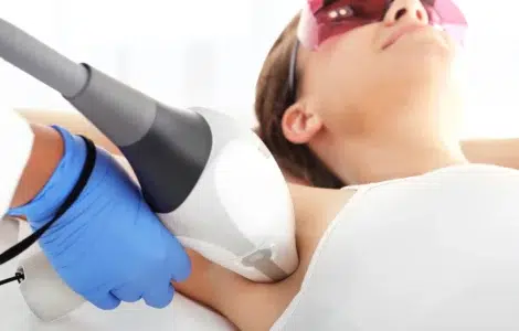 Depilación Láser en axilas con Vectus