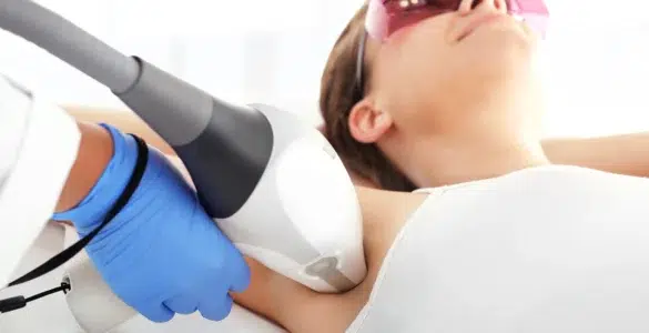 Depilación Láser en axilas con Vectus