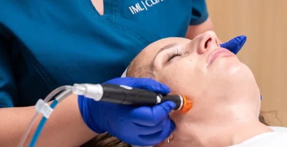 Hydrafacial: Tratamiento pre boda para novias e invitadas