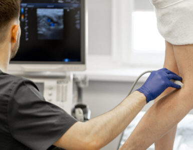 Varices: 8 mitos que debes dejar de creer