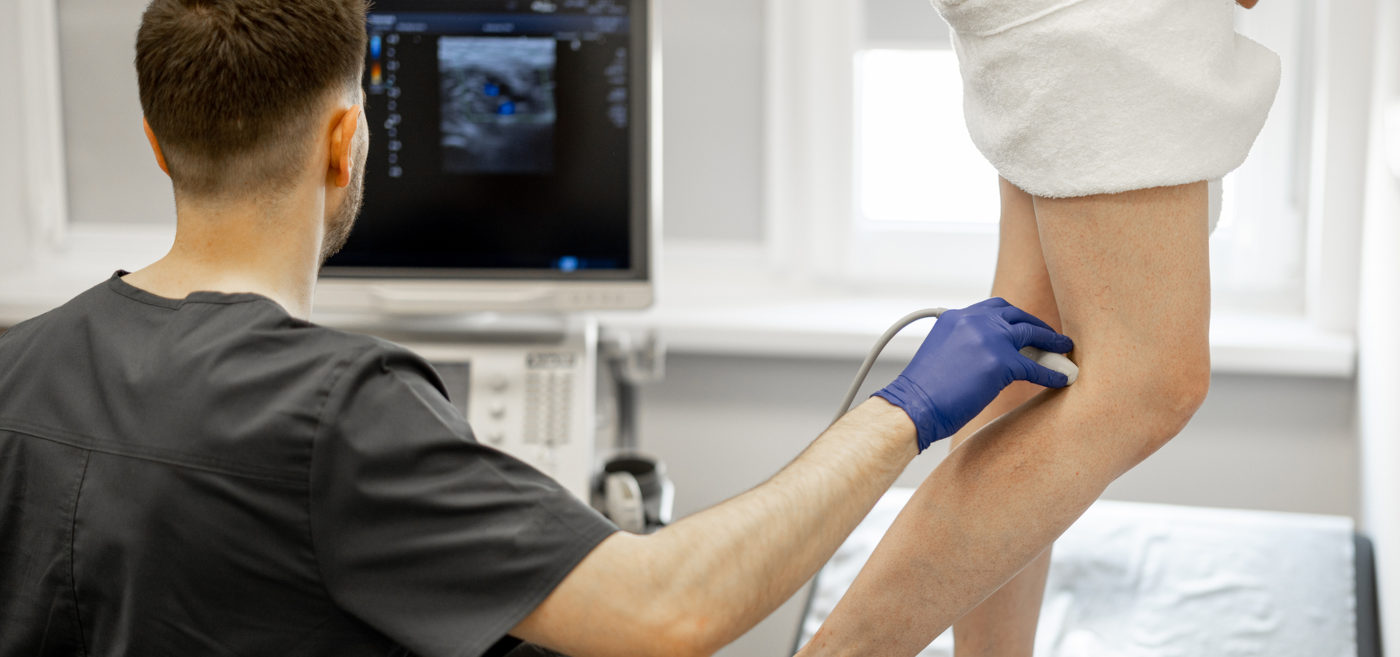 Varices: 8 mitos que debes dejar de creer